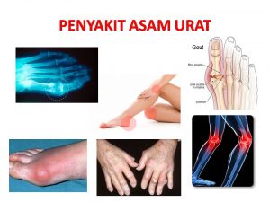 Obat Asam Urat